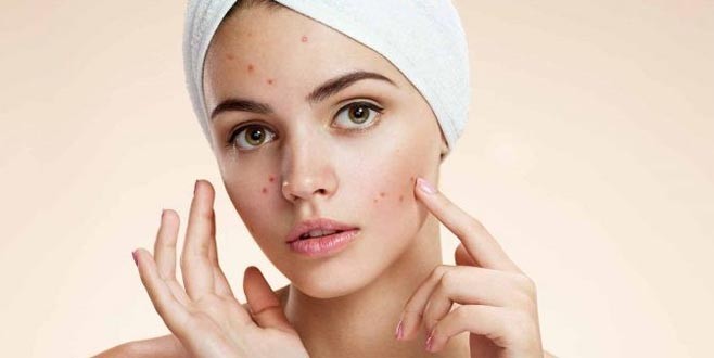 Sivilce lekelerinizden kurtulun!