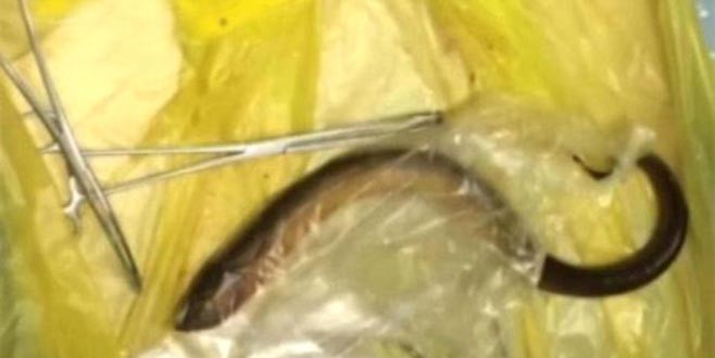 Karnı ağrıyor diye hastaneye gitti anüsünden yılan balığı çıktı