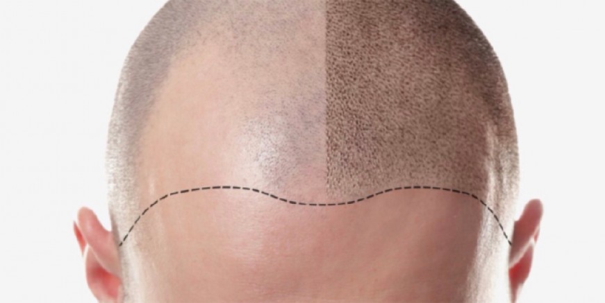 Son teknoloji ile ağrısız saç ekimi