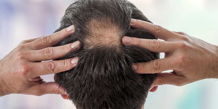 Saç dökülmesini tetikleyen nedenler!