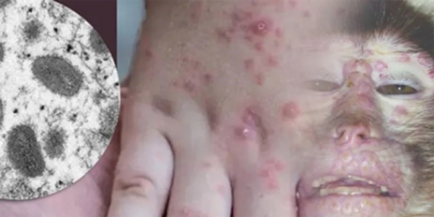 Maymun çiçeği virüsü nedir, belirtileri nelerdir?