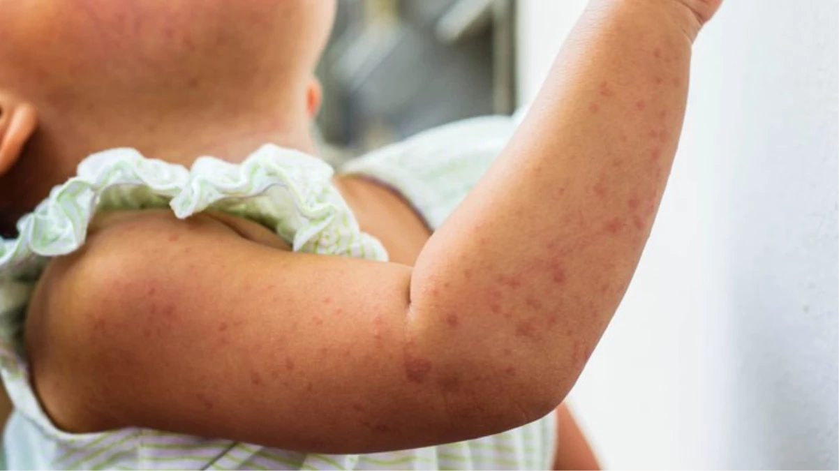 Kızamık vakalarında artış var, vakaların yüzde 86’sı İstanbul’da