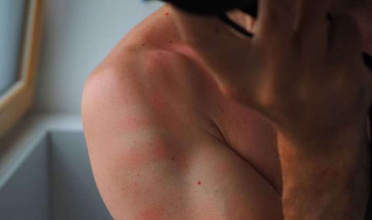 Vakalar artmaya devam ediyor uzmanlardan uyuz uyarısı