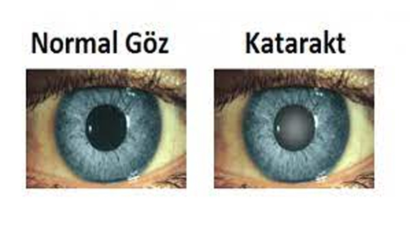 Çocuklar da katarakt sorununa dikkat!