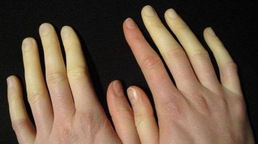 Soğuk havaların tetiklediği Reyno hastalığına dikkat!