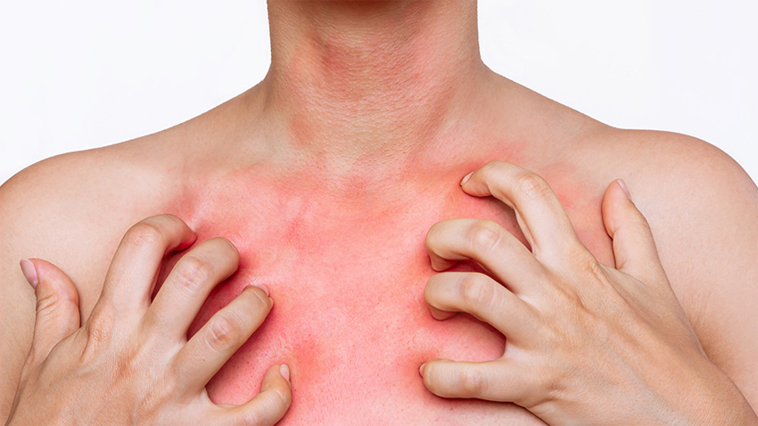 Uyuz vakaları artıyor