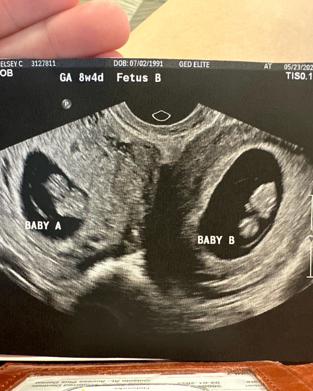 Milyonda bir olasılık gerçekleşti Çift rahimle doğan ABD'li kadın iki bebek bekliyor