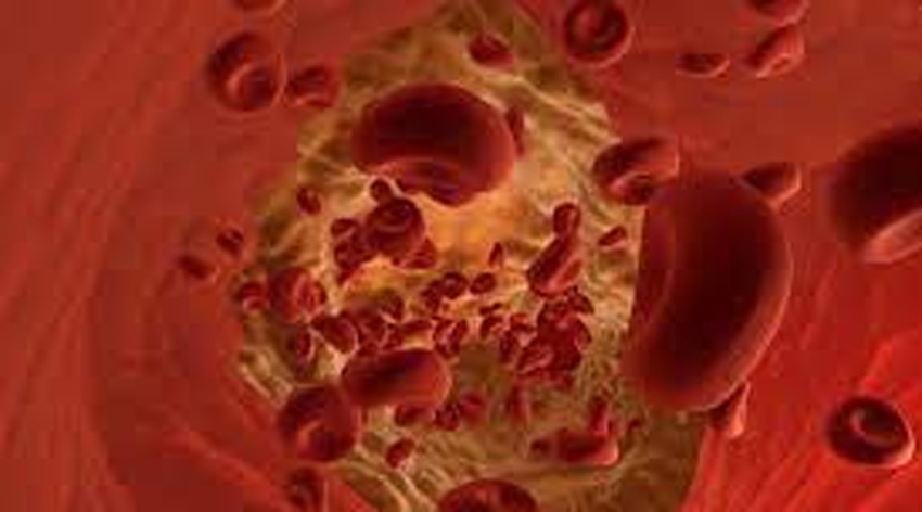 Pıhtı atması nedir?