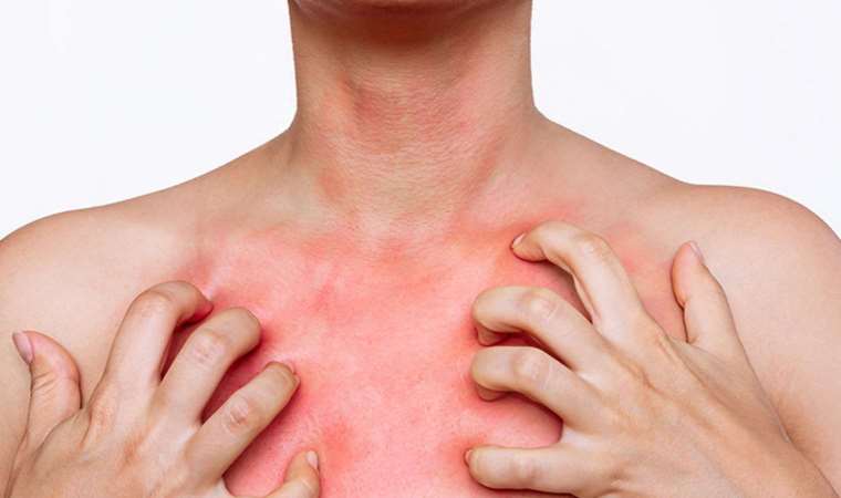 Gece kaşıntıları uyuz belirtisi olabilir!