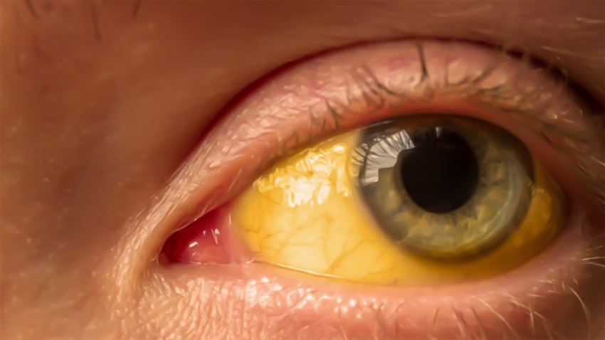 Sarı nokta hastalığı nedir ?