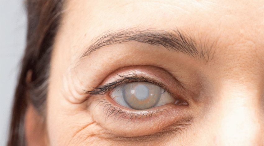 Tavuk karası nedir?