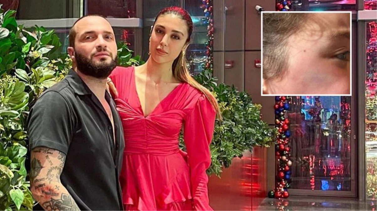 Kızlarının yüzüne mobilya düşmüştü! Berkay’ın eşi öfke kustu