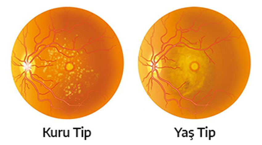 Sarı nokta hastalığı nedir?
