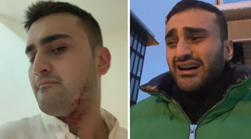 CZN Burak’ın vücudu kesikler içinde!