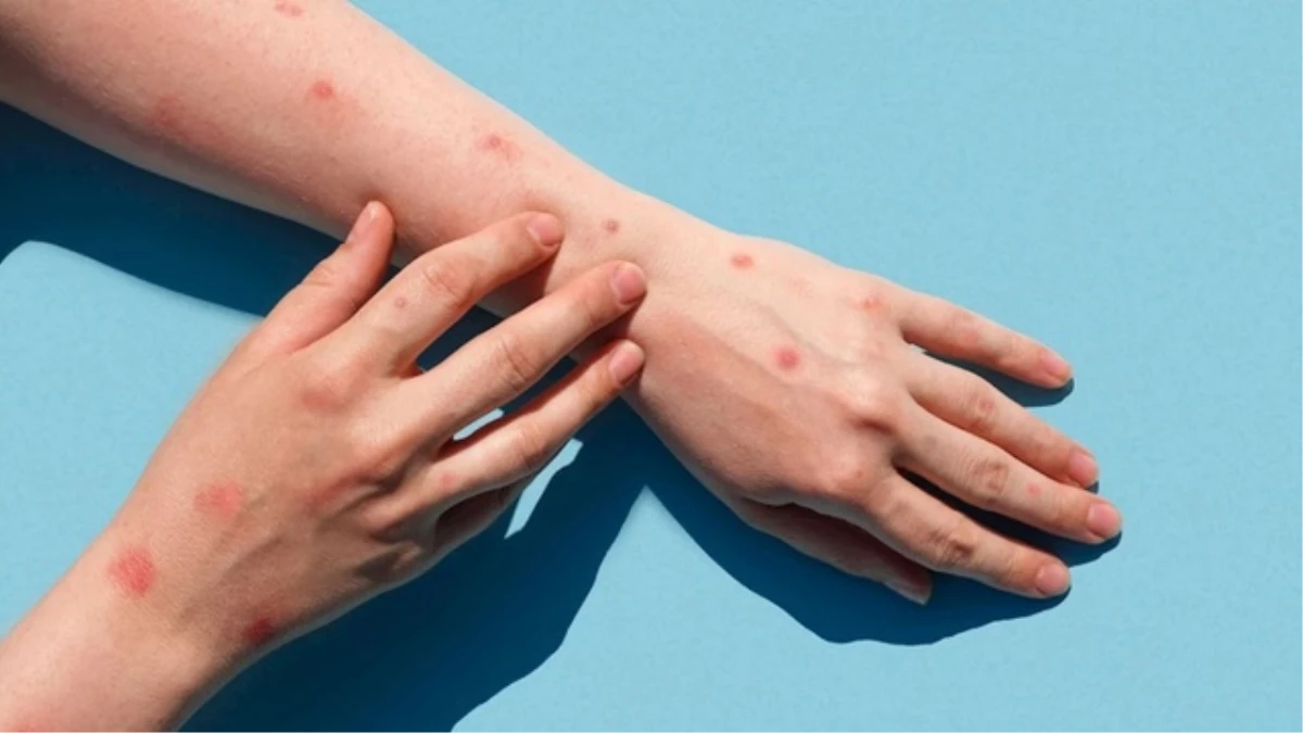 Maymun çiçeği virüsü belirtileri neler?